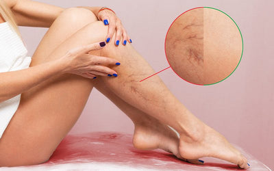 Spider veins, how do I know if I am at risk of developing them?